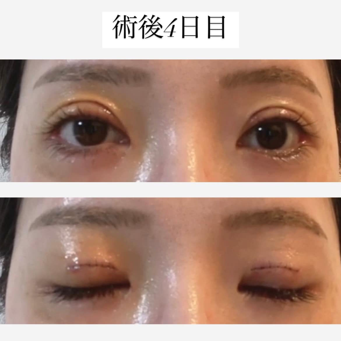 術後4日目