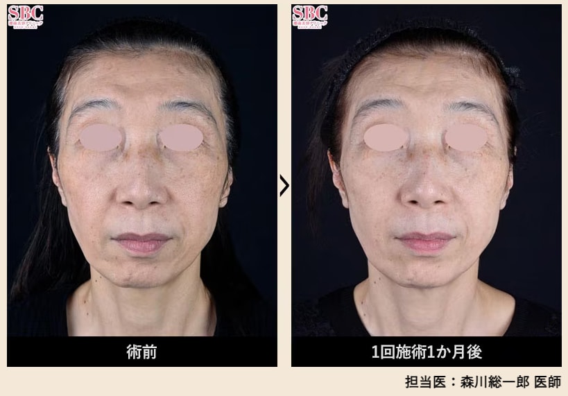 肌全体のハリ・ツヤ感アップ