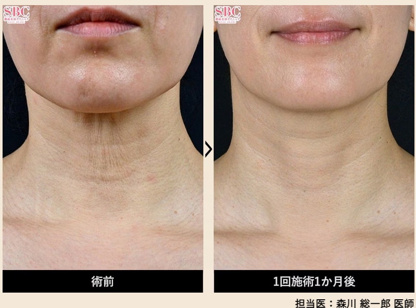 たるみ・エイジングケア効果