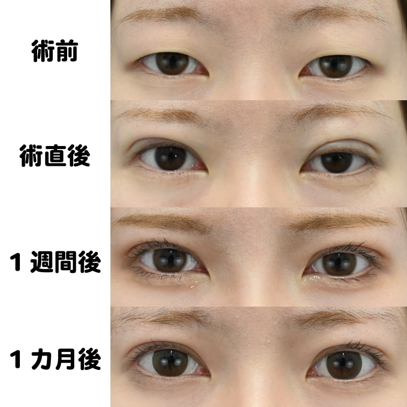 デカ目術のダウンタイム