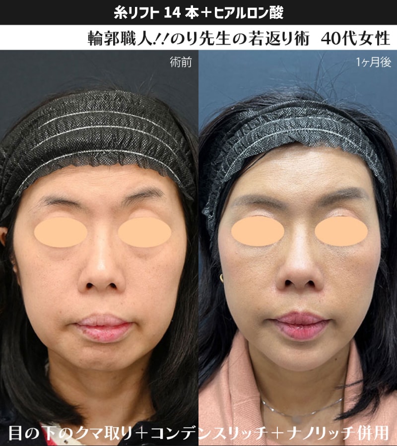 糸リフトの役割:物理的な引き上げ