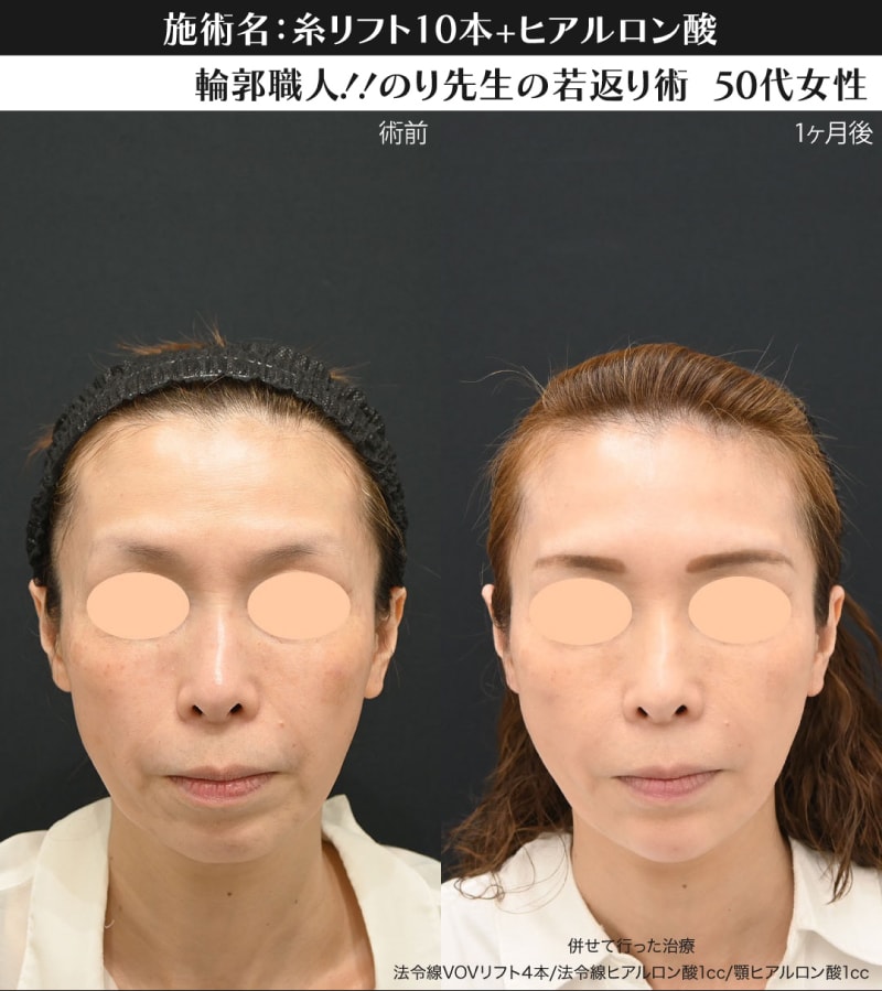 ヒアルロン酸の役割:失われたボリュームの補給