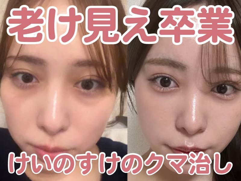 「疲れてる?」はもう言わせない!【SBC川崎院】佐藤けいのすけ院長のクマ取り治療で老け見え卒業!