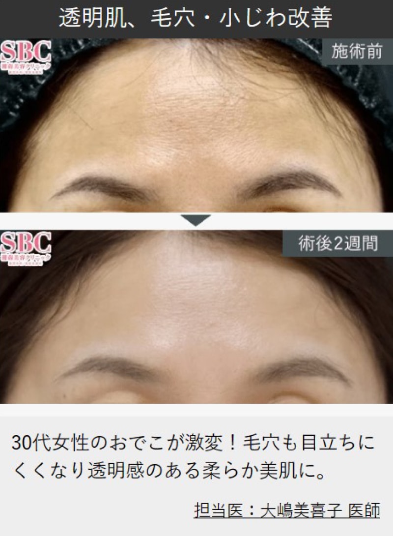 ①女優注射