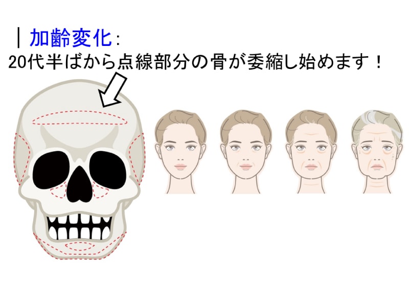 原因②:骨の萎縮・変化