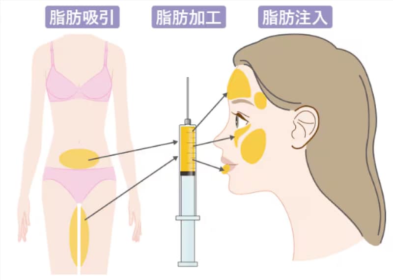 脂肪注入