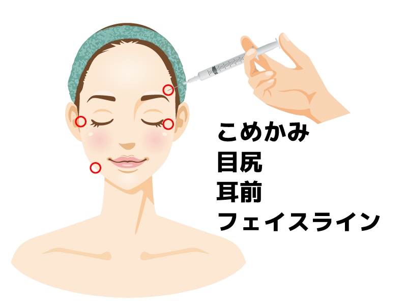 リフトアップ効果も期待できる注入箇所
