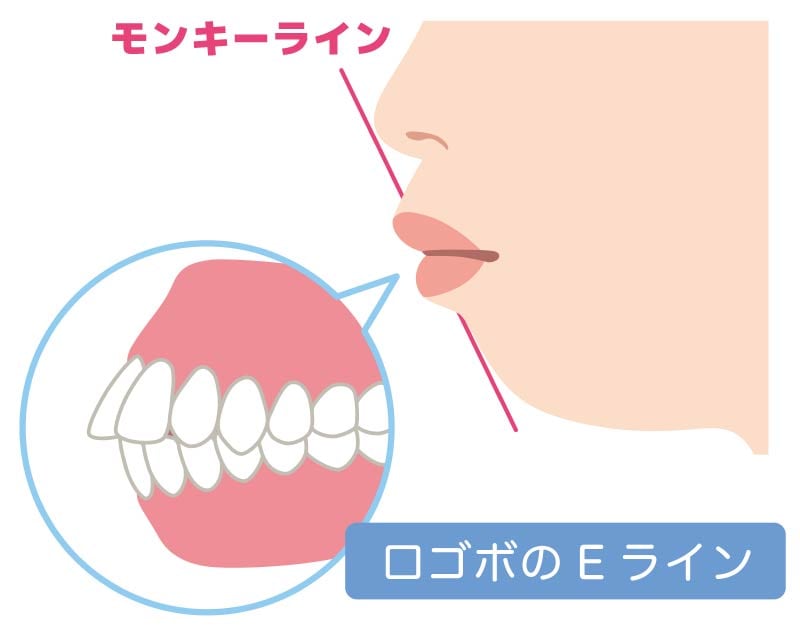 口ゴボについて詳しく解説