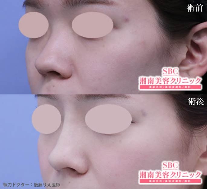 アゴ下だけでなく、鼻筋にも☆