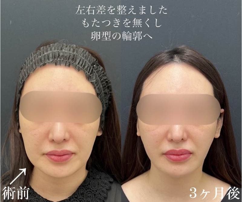  左右差・ほうれい線へのアプローチが可能