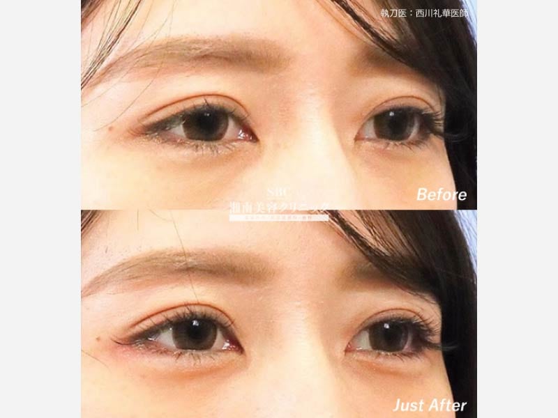 涙袋のヒアルロン酸