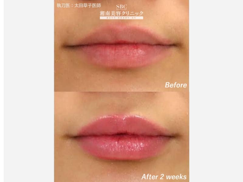 唇のヒアルロン酸