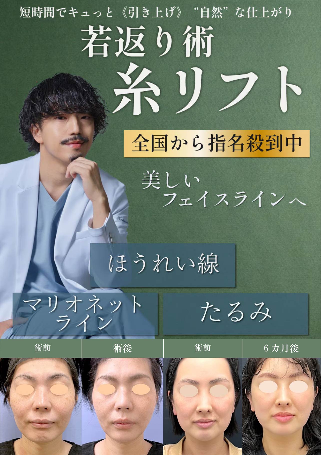 糸リフトも得意です✨