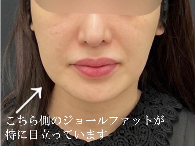 ジョールファット除去すると頬がコケるって本当？