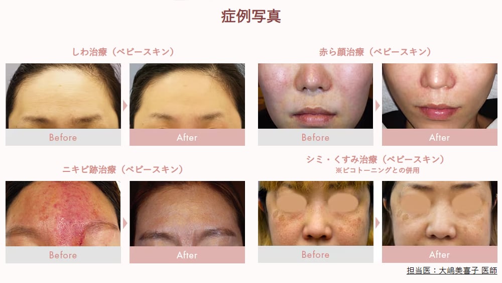 美肌への近道！】湘南美容クリニックのエレクトロポレーション（イオン