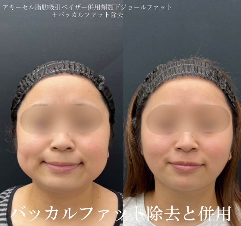 バッカルファット除去も得意