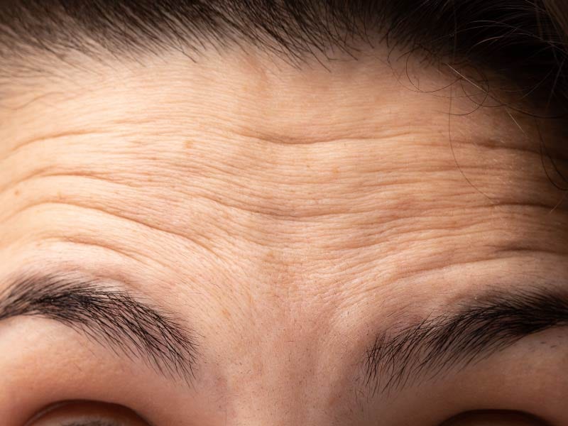 ②おでこのシワ改善