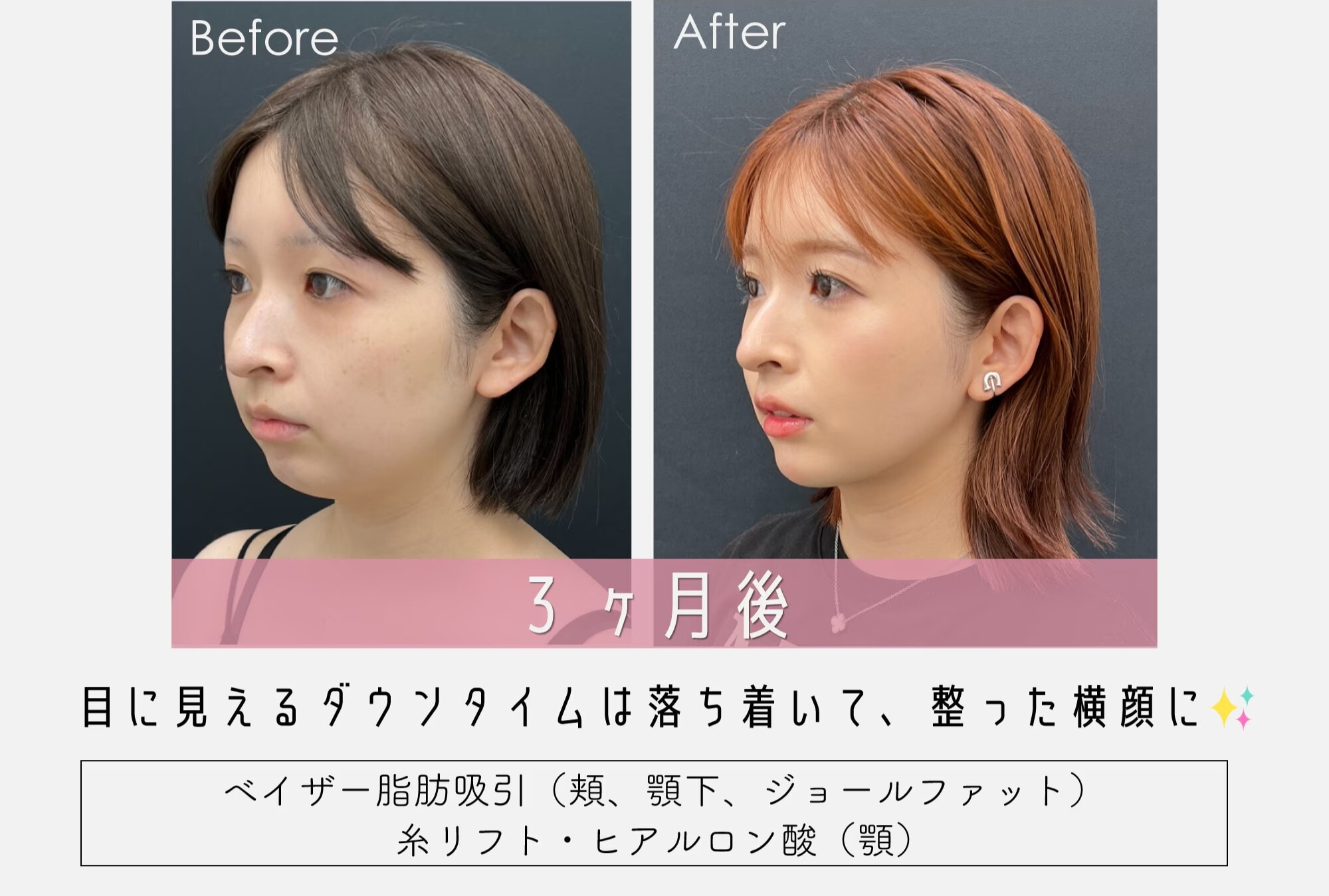 💎 新院長・佐藤圭之輔医師の推し治療「垢抜け✨小顔脂肪吸引」に注目！