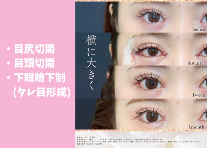 「可愛い」を諦めない!たった1ヶ月で理想な目元に✨