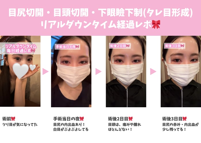 目尻切開・目頭切開・下眼瞼下制(タレ目形成)リアルダウンタイム経過レポ🎀