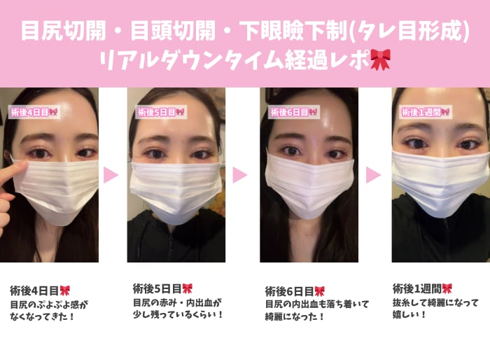 目尻切開・目頭切開・下眼瞼下制(タレ目形成)リアルダウンタイム経過レポ🎀