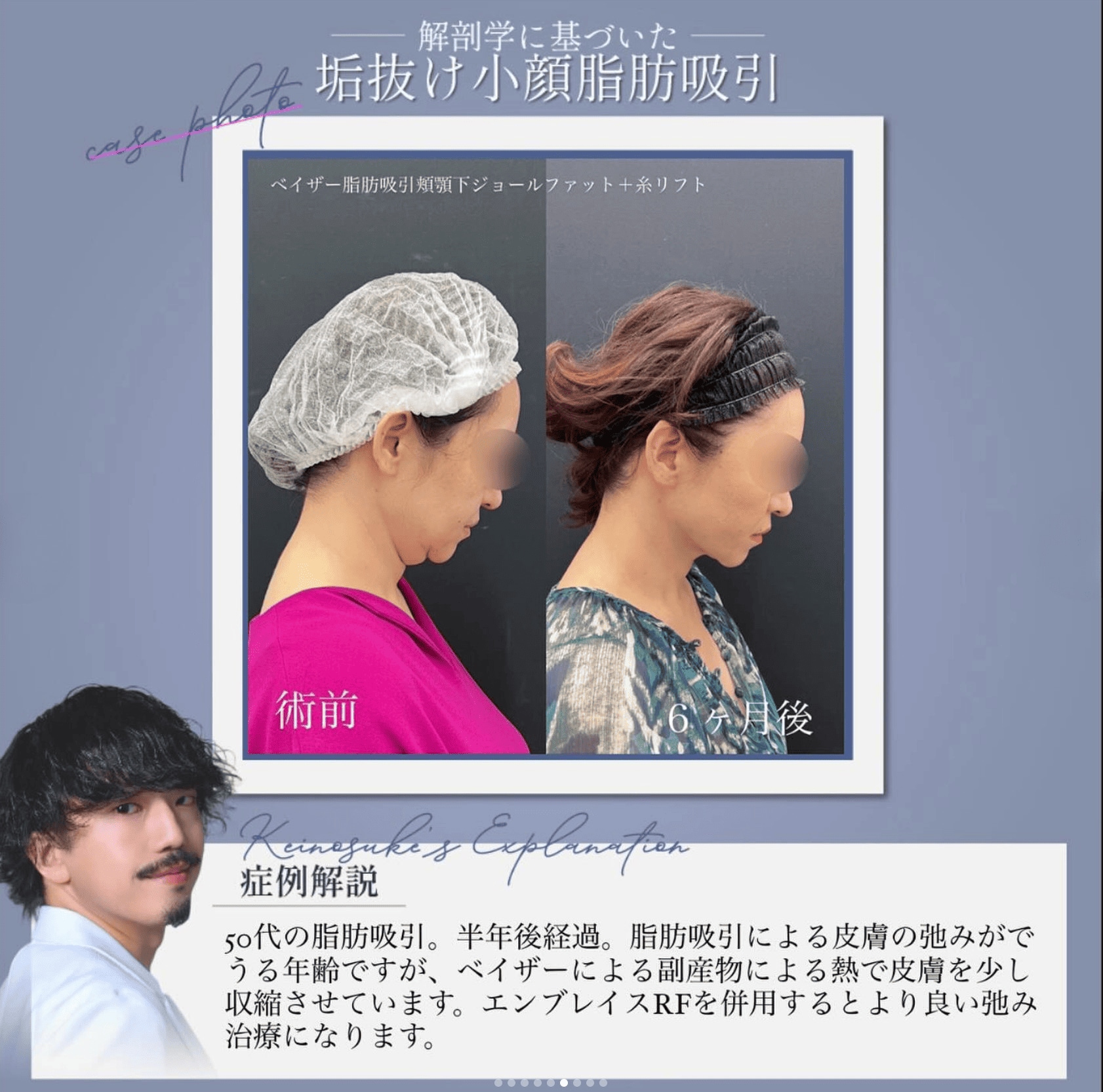 解剖学に基づく垢抜け小顔脂肪吸引🩷