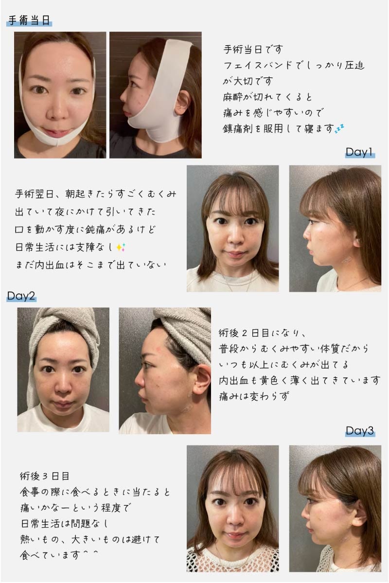 必見👀ダウンタイムに密着！！《手術当日〜3日目》