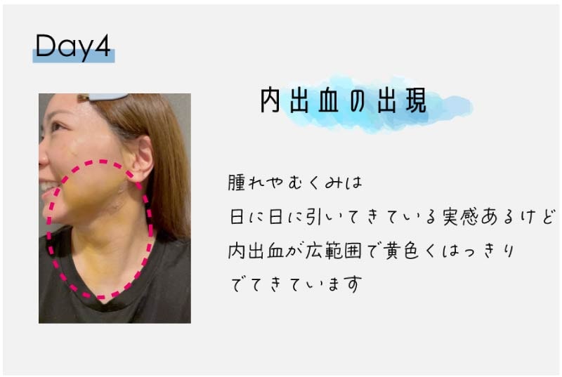 必見👀ダウンタイムに密着！！《4日目〜7日目》