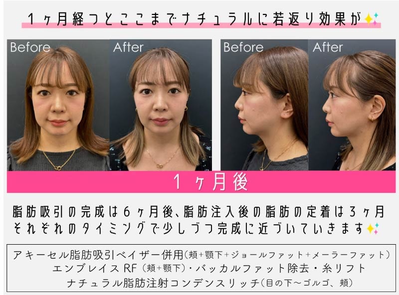 【症例写真】気になる１ヶ月後…✨