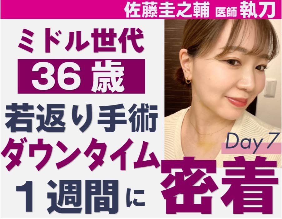 術後1週間でこの完成度！脂肪吸引複合術で叶える究極の若返り【SBC名医監修】