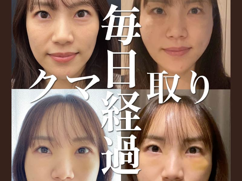 【目の下のクマ・たるみ解消特集】けいのすけ院長が叶える、自然な若返り術【ダウンタイム経過】