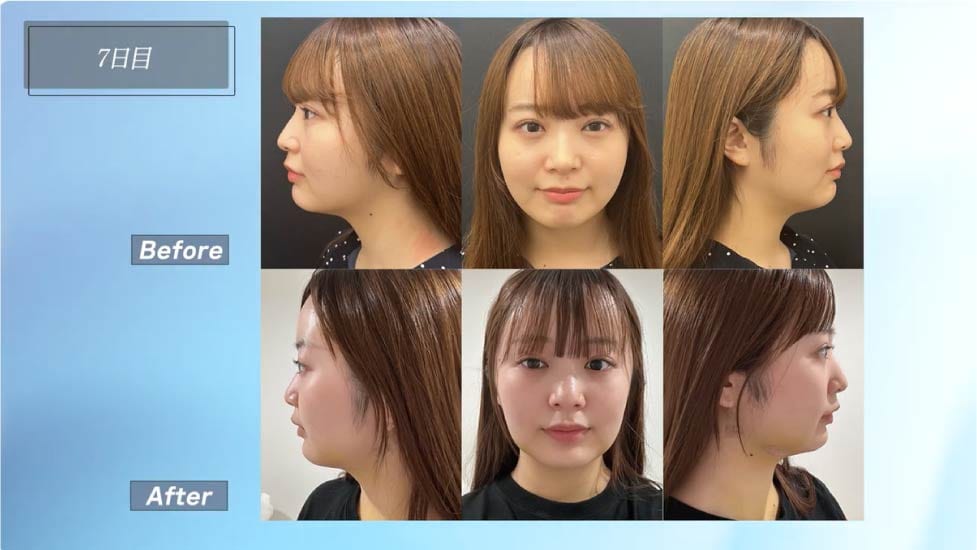 術後1週間：黄色味が消えてくる