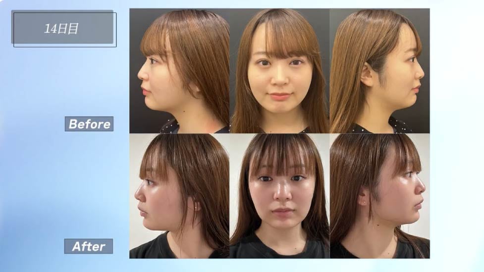 術後2週間：フェイスラインがくっきり！