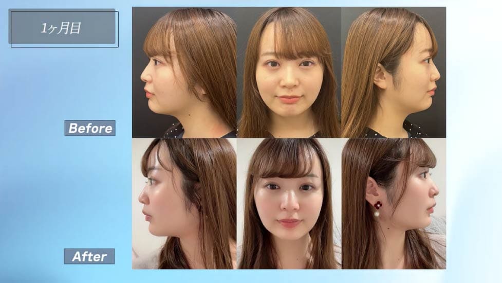 術後1ヶ月：自然な小顔を実感