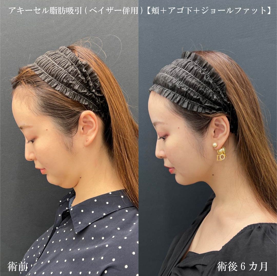 二重アゴが解消されました⭐