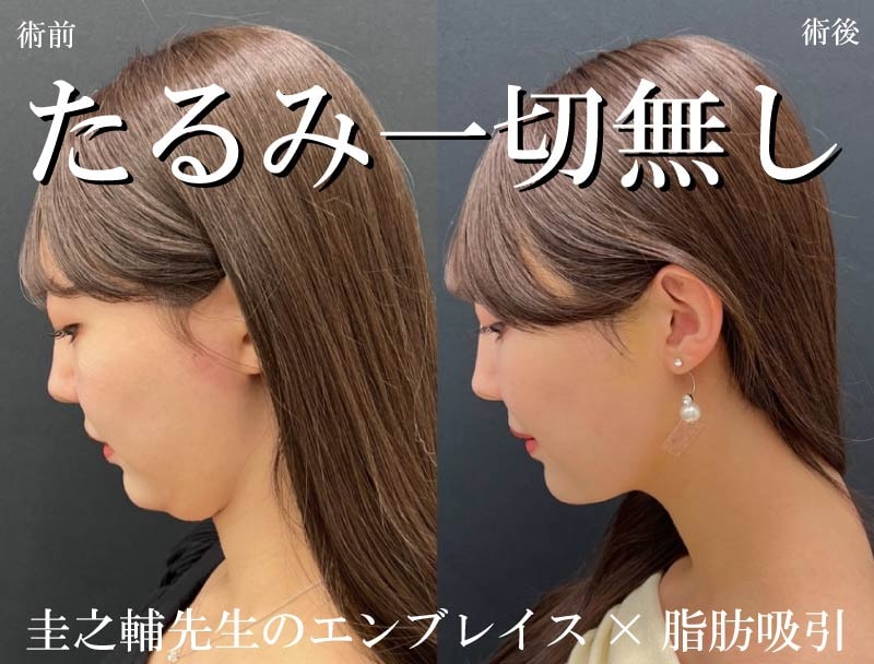 脂肪吸引×エンブレイスはなぜ良い？