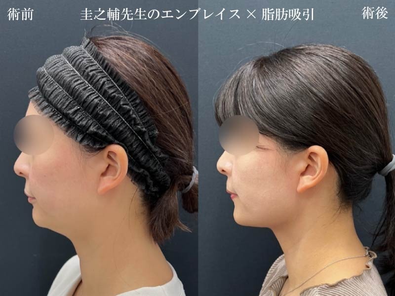 1. 圧倒的なたるみ予防・改善効果