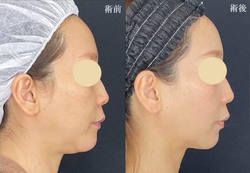 ①エンブレイス単体での治療