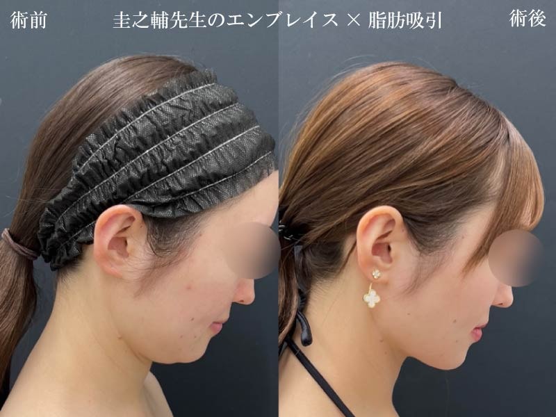 ②脂肪吸引とエンブレイスの併用