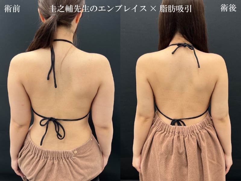 二の腕の振袖部分