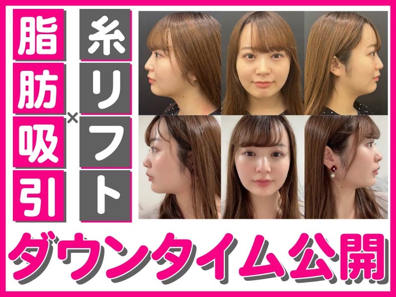 小顔脂肪吸引のダウンタイムは何日続く？術後1日から1ヶ月の腫れ・痛みを徹底比較【保存版】