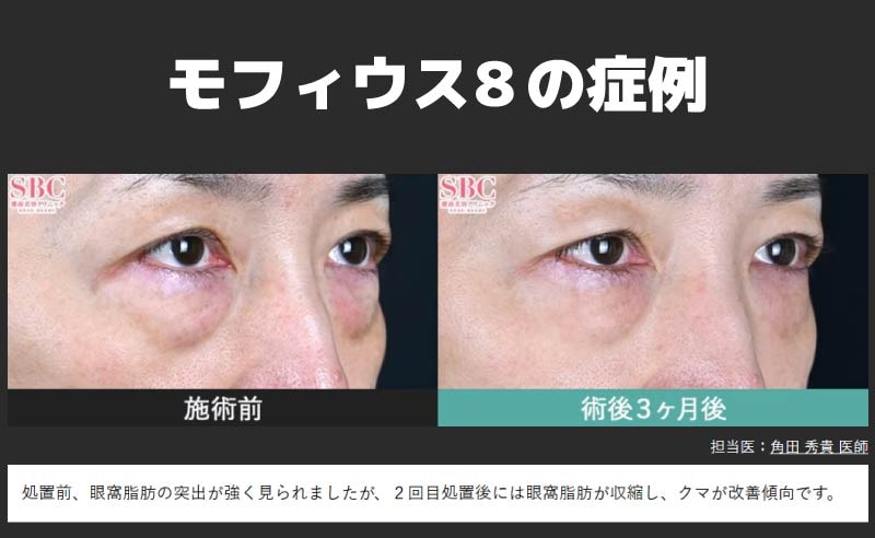 眼窩脂肪へ直接アプローチ