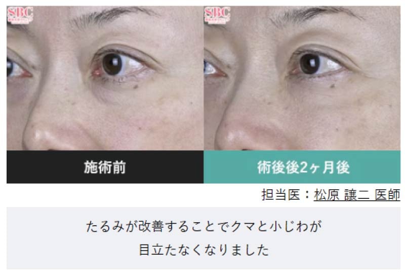 深い部分の皮膚引き締め