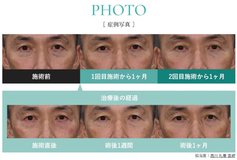 短いダウンタイム