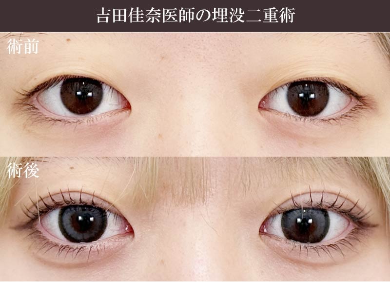 ① 形成外科専門医として：繊細な技術が光る目元・切開手術