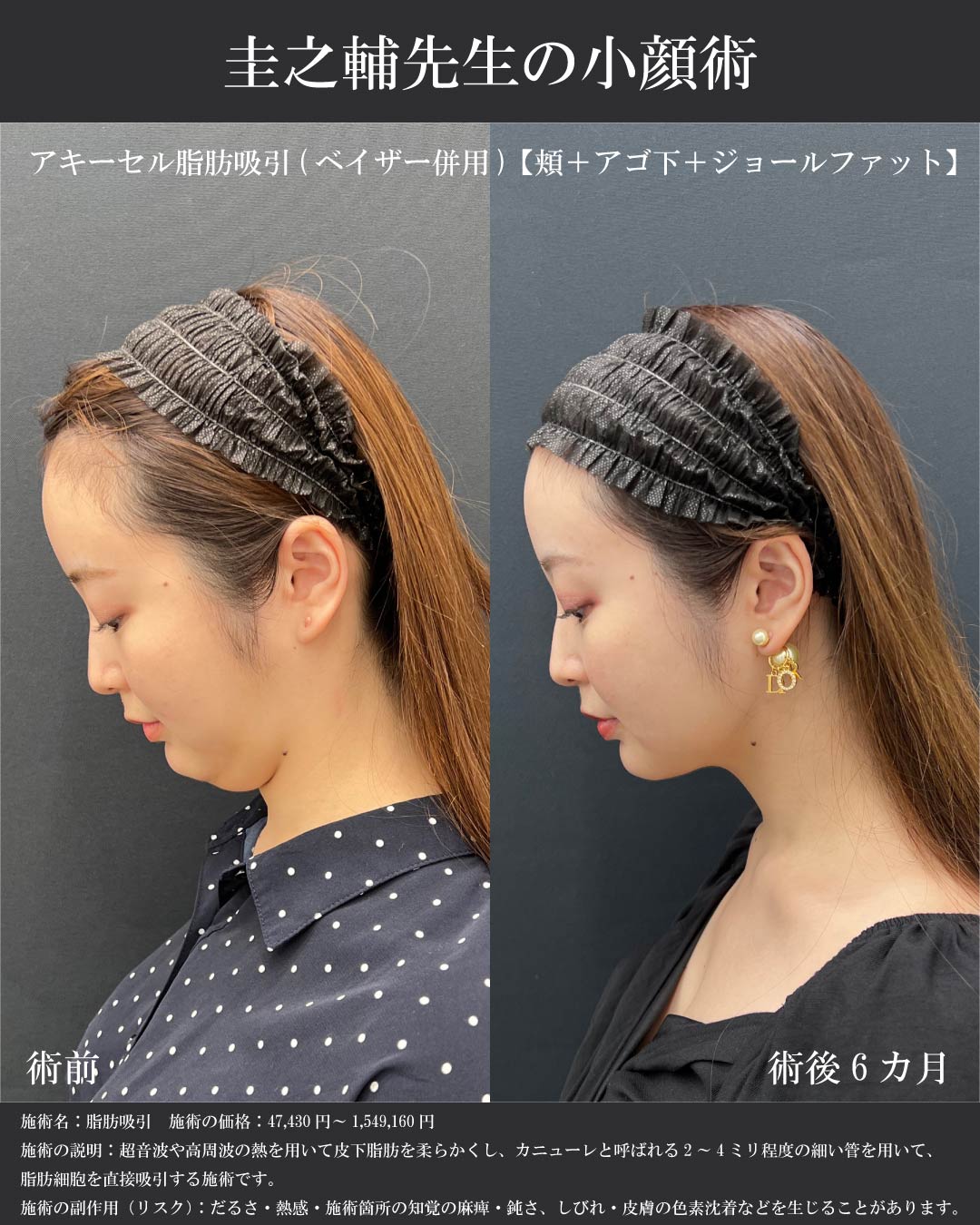 二重アゴが解消されました⭐