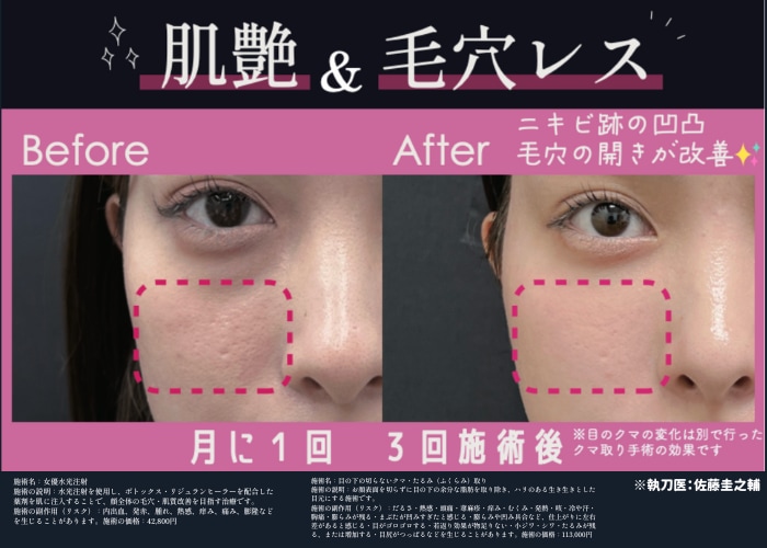 ＼ 女優水光注射で叶った、<b>劇的なビフォーアフター</b>を公開！ ／