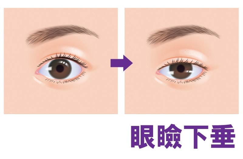 眼瞼下垂って何？