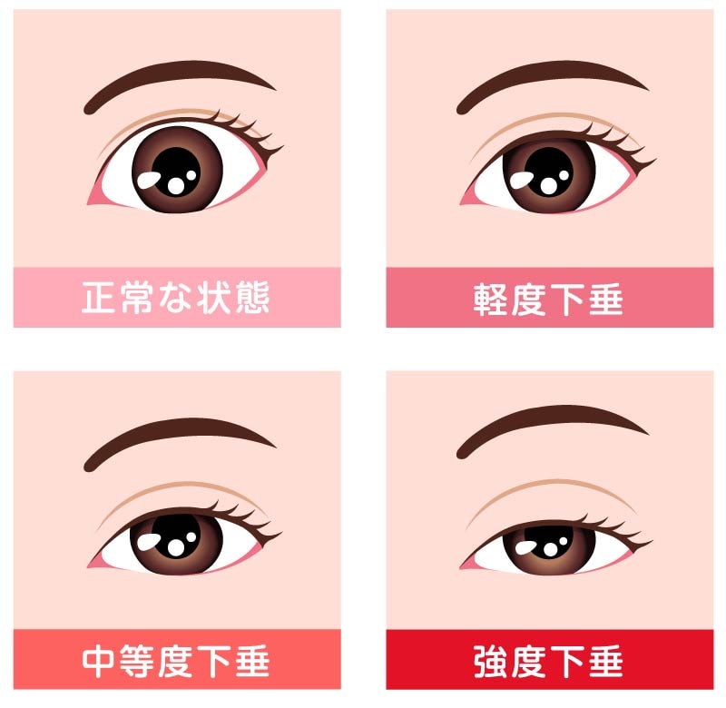 眼瞼下垂の4つのデメリット