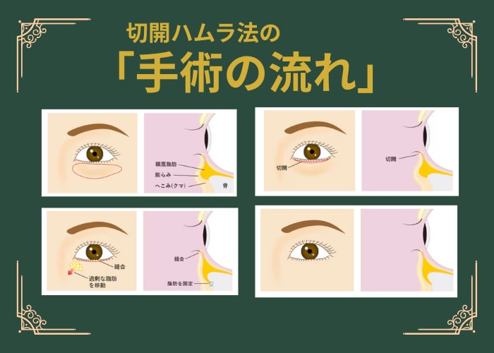 切開ハムラ法の手術の流れ（イメージ）<br />
